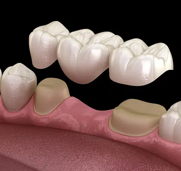 dental crowns and bridges in union - duo dental group