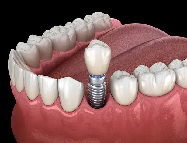 dental implants in union - duo dental group